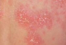 Caso di scabbia a Modena città